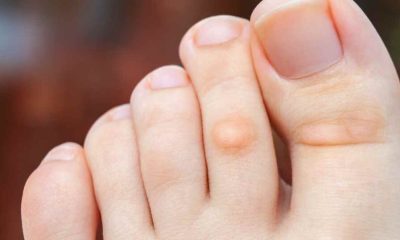 Blisterata